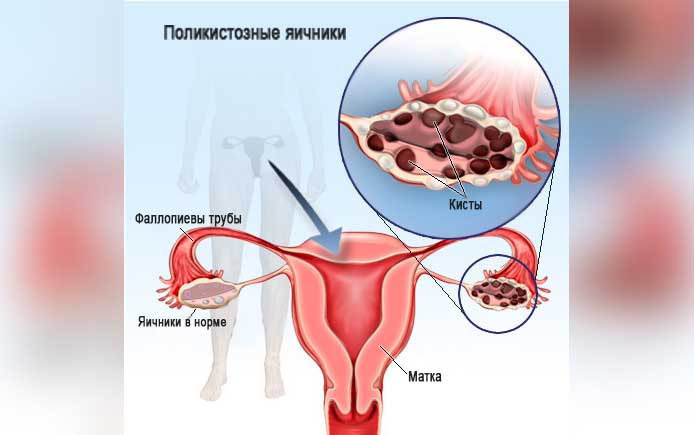 Кисты на поверхности яичника Кисты на поверхности яичника