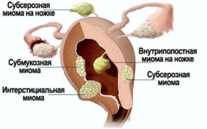 Разновидности миом Разновидности миом