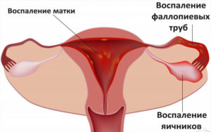 Воспаление половых органов женщины Воспаление половых органов женщины